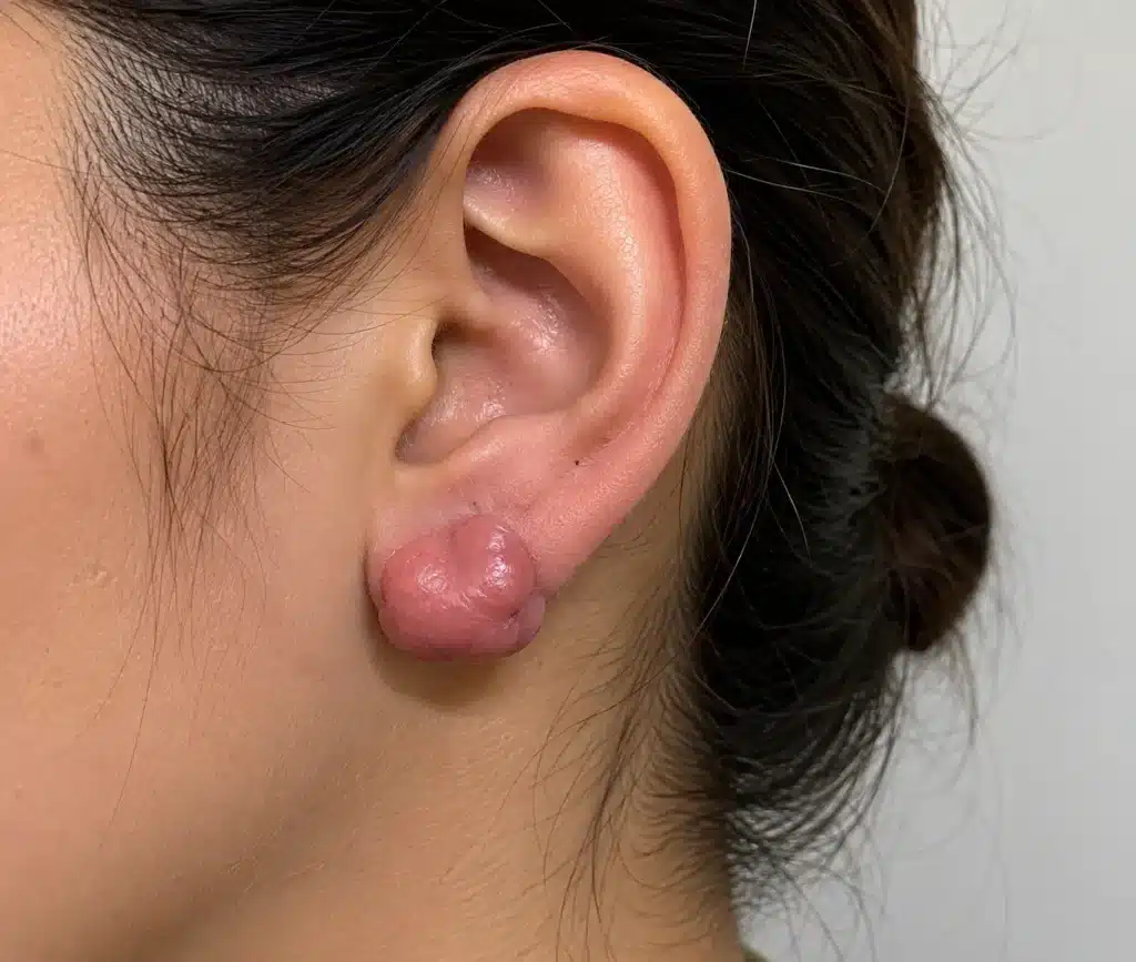Portrait rapproché d’une femme avec une petite chéloïde discrète au lobe de l’oreille après un piercing.